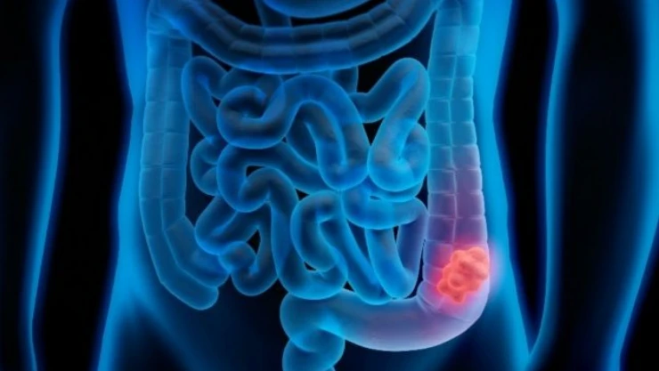 Bir Yılda 900 Bin Kişi Bu Kanserden Öldü!